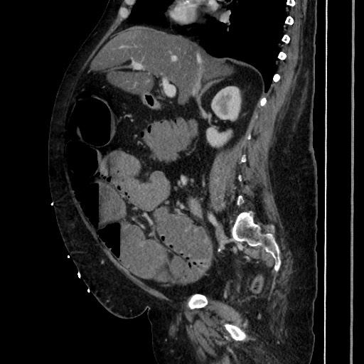 Obstructive colonic diverticular stricture (Radiopaedia 81085-94675 C 104).jpg