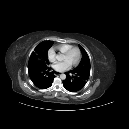 Obstructive distal colonic adenocarcinoma causing cecal perforation (Radiopaedia 86830-102989 A 12).jpg