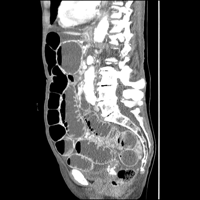 Obturator hernia causing small bowel obstruction (Radiopaedia 65522-74612 C 46).jpg