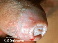 File:Penile lichen sclerosus (DermNet NZ 092-small).jpg