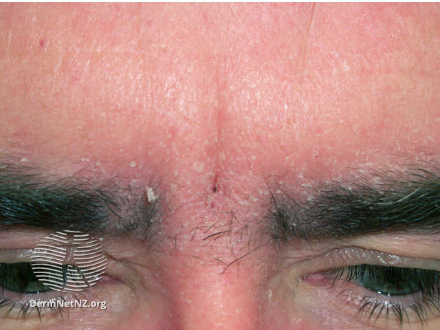 File:Seborrhoeic dermatitis (DermNet NZ dermatitis-sebderm4).jpg