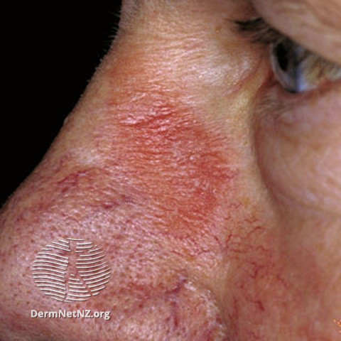File:(DermNet NZ dermatitis-acd-face-2440).jpg