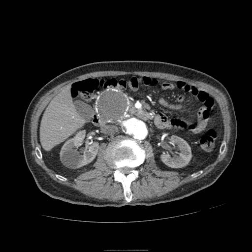 File:Abdominal aortic aneurysm (Radiopaedia 13341-13340 Axial C+ arterial phase 83).jpg