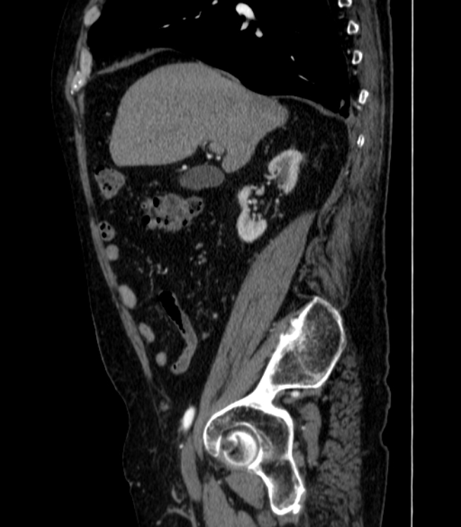 Abdominal aortic aneurysm (Radiopaedia 25855-26001 Sagittal C+ arterial phase 1).jpg