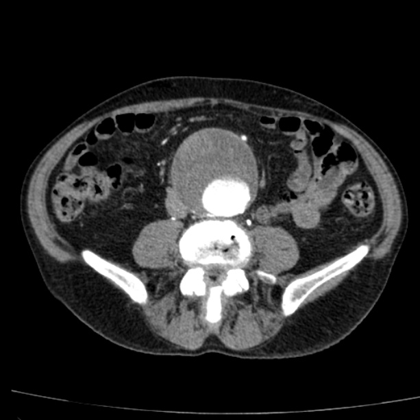Abdominal aortic aneurysm (Radiopaedia 29248-29660 Axial C+ arterial phase 52).jpg