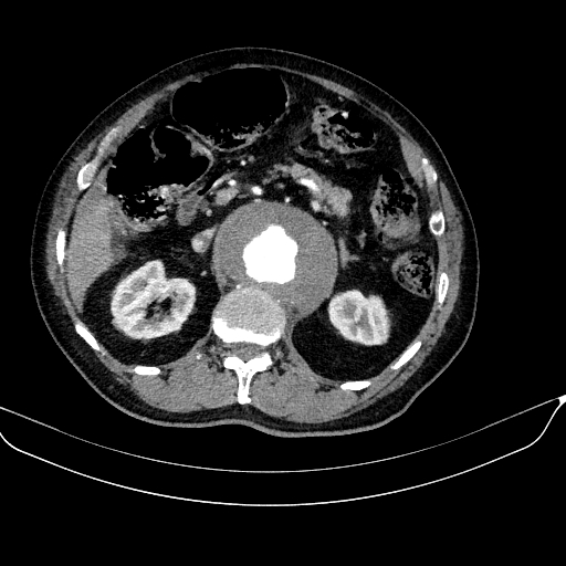 File:Abdominal aortic aneurysm (Radiopaedia 67117-76452 Axial C+ arterial phase 47).jpg