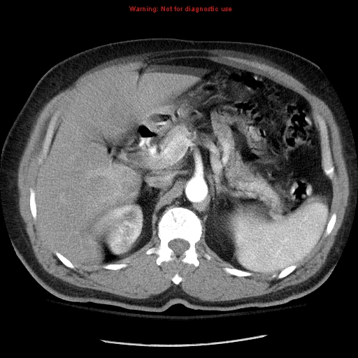 Abdominal aortic aneurysm (Radiopaedia 8190-9038 Axial C+ arterial phase 26).jpg
