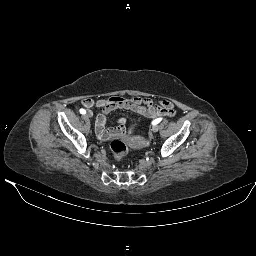 File:Abdominal aortic aneurysm (Radiopaedia 85063-100606 Axial C+ arterial phase 58).jpg