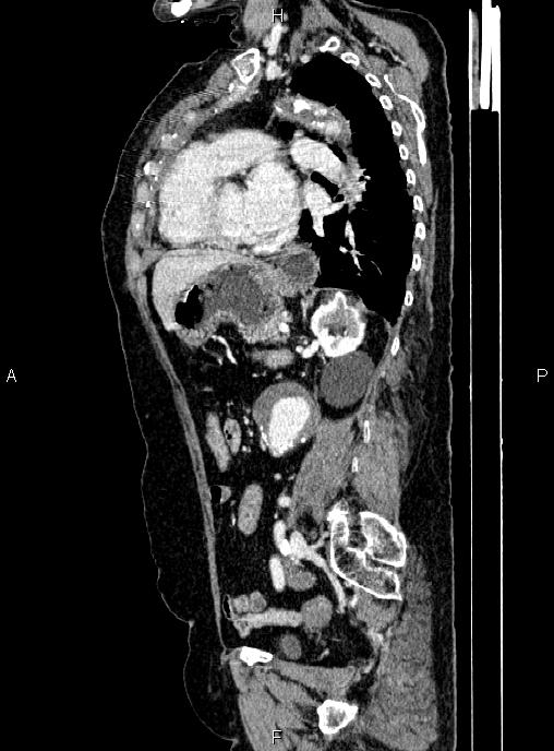 Abdominal aortic aneurysm (Radiopaedia 85063-100606 Sagittal C+ arterial phase 53).jpg