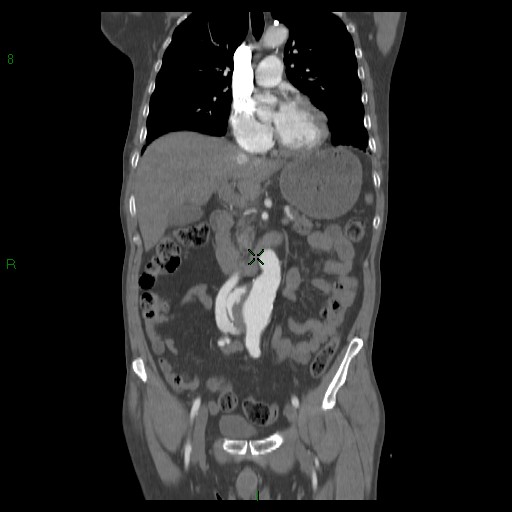 File:Abdominal aortic aneurysm rupture with aortocaval fistula (Radiopaedia 14897-14841 Coronal C+ arterial phase 23).jpg