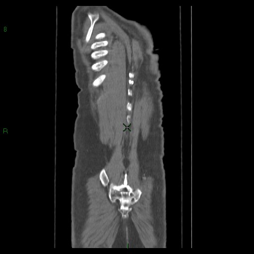 File:Abdominal aortic aneurysm rupture with aortocaval fistula (Radiopaedia 14897-14841 Coronal C+ arterial phase 39).jpg