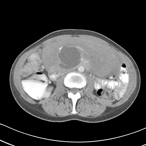 Abdominal desmoid tumor (Radiopaedia 41007-43740 Axial C+ portal venous phase 32).png