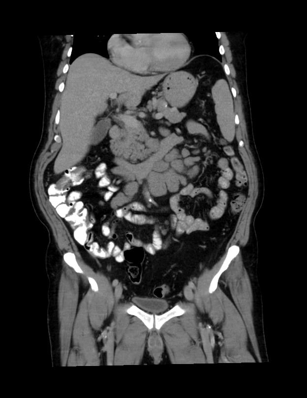 Abdominal lymphoma - with sandwich sign (Radiopaedia 53486-59492 C+ portal venous phase 34).jpg