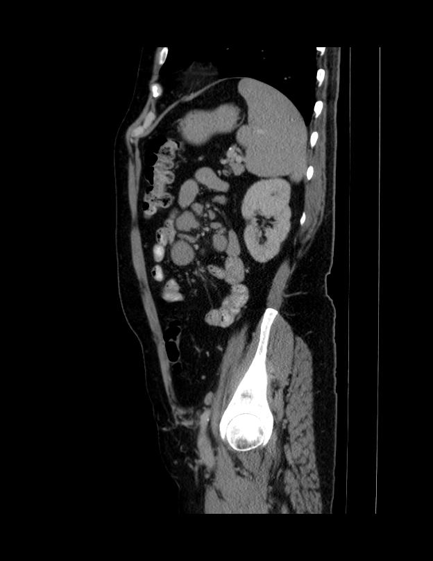Abdominal lymphoma - with sandwich sign (Radiopaedia 53486-59492 Sagittal C+ portal venous phase 19).jpg