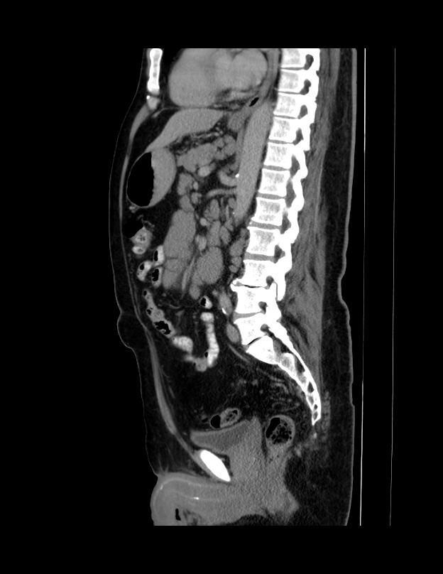 Abdominal lymphoma - with sandwich sign (Radiopaedia 53486-59492 Sagittal C+ portal venous phase 36).jpg