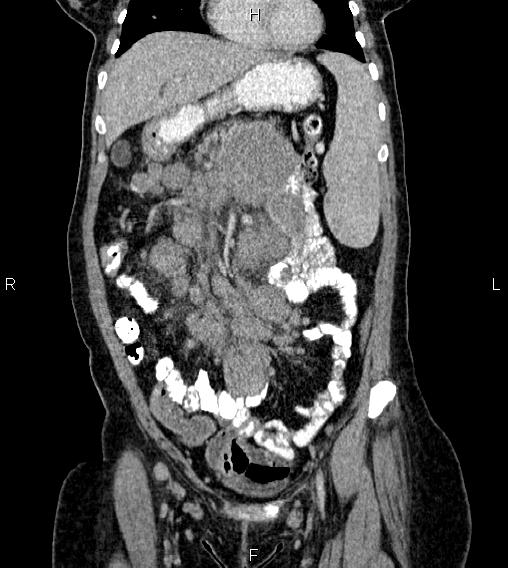 Abdominal lymphoma with sandwich sign (Radiopaedia 84378-99704 Coronal C+ portal venous phase 15).jpg