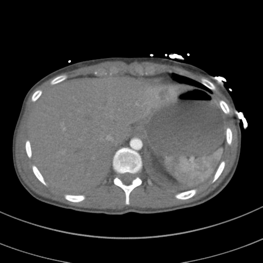 File:Abdominal multi-trauma - devascularised kidney and liver, spleen and pancreatic lacerations (Radiopaedia 34984-36486 Axial C+ arterial phase 77).png