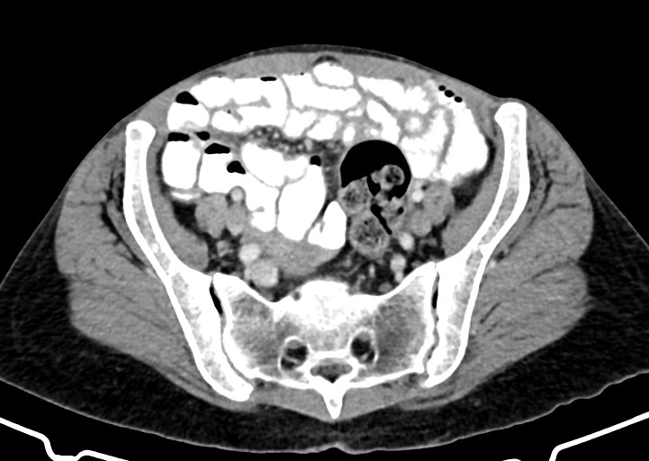 Abdominal wall and retroperitoneal tuberculosis (Radiopaedia 88137-104729 Axial C+ portal venous phase 145).jpg