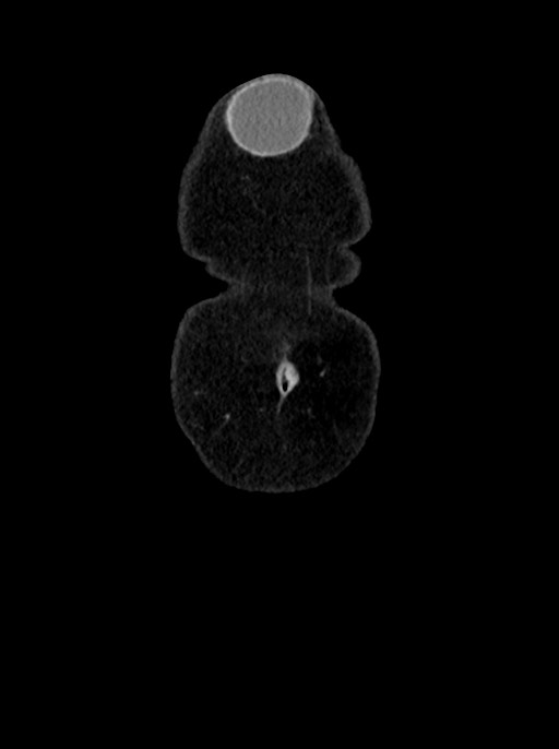 Abdominal wall and retroperitoneal tuberculosis (Radiopaedia 88137-104729 Coronal C+ portal venous phase 6).jpg