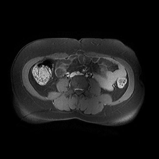 File:Abdominal wall endometriosis (Radiopaedia 83702-98847 Axial T1 C+ fat sat 10).jpg