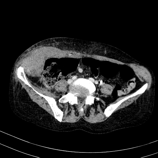 Abdominal wall hematoma with active bleeding (Radiopaedia 83915-99117 Axial C+ portal venous phase 82).jpg