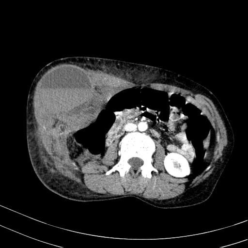 Abdominal wall hematoma with active bleeding (Radiopaedia 83915-99117 Axial renal cortical phase 41).jpg