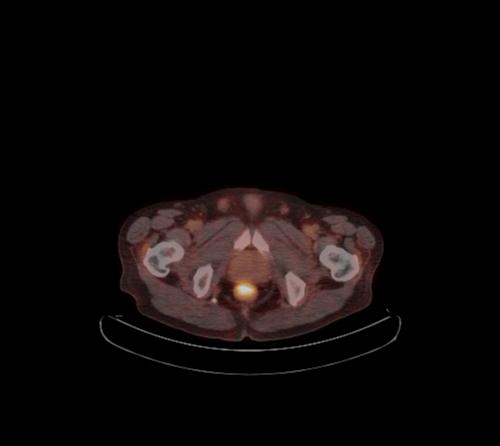 Abdominal wall metastasis from colorectal carcinoma (Radiopaedia 31016-31719 C 19).jpg