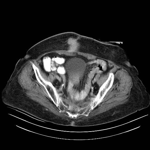 File:Abdominal wall recurrence after colorectal resection for cancer (Radiopaedia 23444-23523 Axial C+ portal venous phase 31).jpg