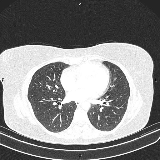 File:Aberrant right subclavian artery (Radiopaedia 87334-103629 Axial lung window 39).jpg