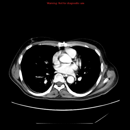 File:Aberrant right subclavian artery (Radiopaedia 9379-10071 Axial C+ arterial phase 36).jpg
