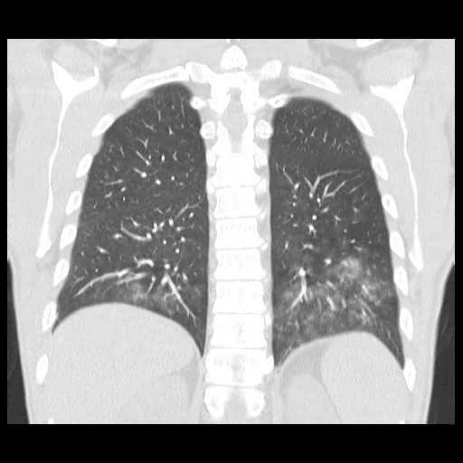Accessory left horizontal fissure with lingular pneumonia (Radiopaedia 53763-59843 Coronal lung window 34).jpg