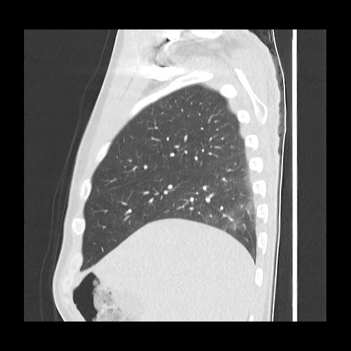 File:Accessory left horizontal fissure with lingular pneumonia (Radiopaedia 53763-59843 Sagittal lung window 18).jpg