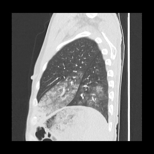 Accessory left horizontal fissure with lingular pneumonia (Radiopaedia 53763-59843 Sagittal lung window 55).jpg