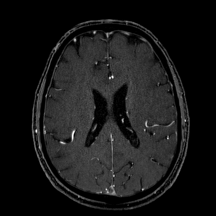 Accessory middle cerebral artery (Radiopaedia 73114-83828 Axial MRA 134).jpg