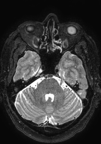 Accessory middle cerebral artery (Radiopaedia 73114-83828 Axial T2 154).jpg