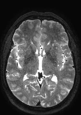Accessory middle cerebral artery (Radiopaedia 73114-83828 Axial T2 72).jpg