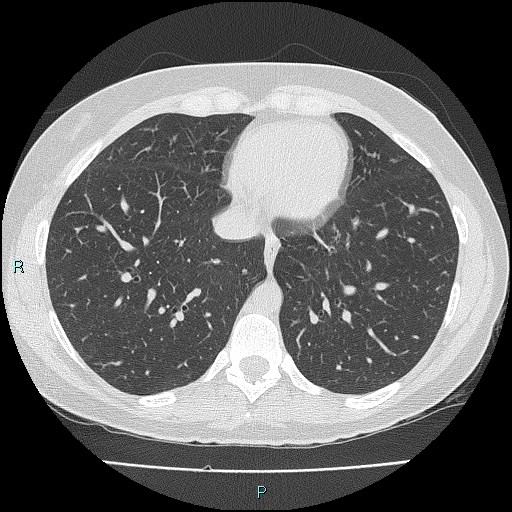 File:Accidental foreign body aspiration (seamstress needle) (Radiopaedia 77740-89983 Axial lung window 47).jpg