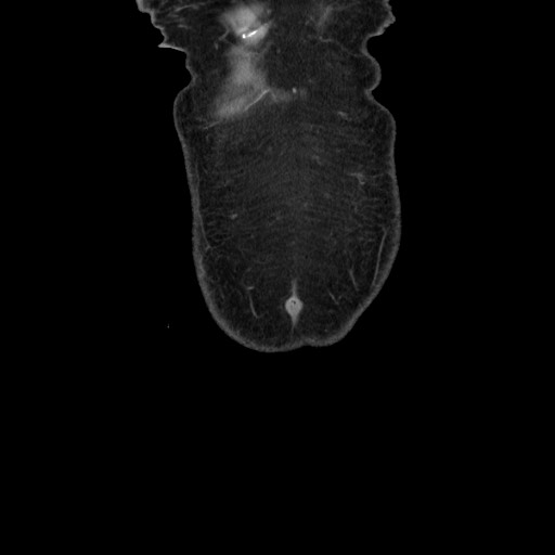 Acinar cell carcinoma of the pancreas (Radiopaedia 75442-86669 Coronal C+ portal venous phase 9).jpg