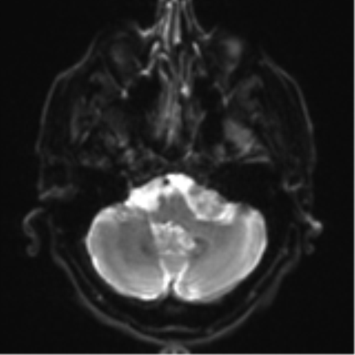 File:Acoustic schwannoma (Radiopaedia 55729-62281 E 4).png
