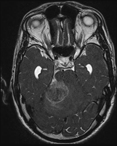 File:Acoustic schwannoma - probable (Radiopaedia 20386-20292 Axial T1 52).jpg