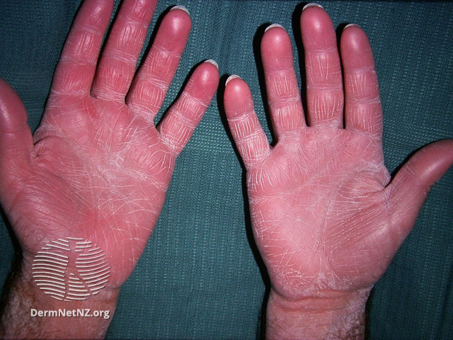 File:Acquired ichthyosis (DermNet NZ scaly-acquired-ichthyosis-1).jpg