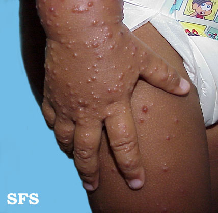 Acrodermatitis Infantile Papular (Dermatology Atlas 6).jpg