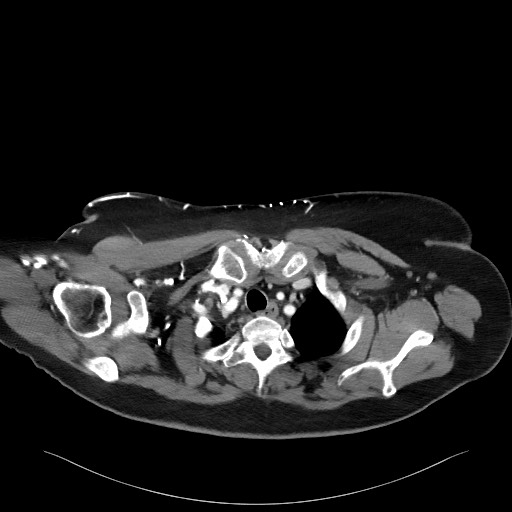 Acromioclavicular joint cyst (Radiopaedia 58455-65610 Axial C+ arterial phase 25).jpg