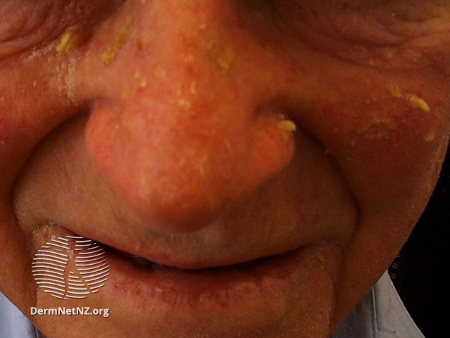 Actinic Keratoses affecting the face (DermNet NZ lesions-ak-face-465).jpg