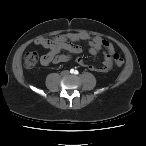 File:Active colonic bleed on CT (Radiopaedia 49765-55025 Axial C+ arterial phase 51).jpg