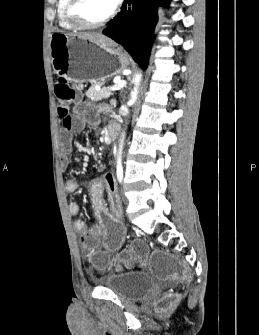 Active crohn disease (Radiopaedia 87133-103397 Sagittal C+ arterial phase 52).jpg