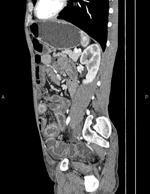 Active crohn disease (Radiopaedia 87133-103397 Sagittal C+ arterial phase 60).jpg