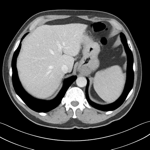File:Active diverticular hemorrhage (Radiopaedia 39415-41725 Axial C+ portal venous phase 10).png