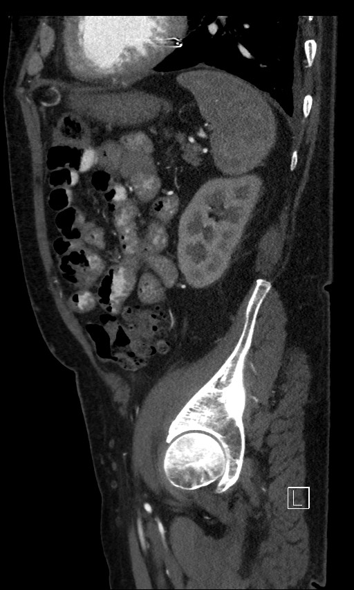 Active lower gastrointestinal bleeding - diverticular (Radiopaedia 61203-69106 Sagittal C+ arterial phase 40).jpg