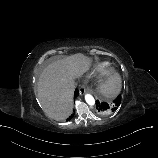 File:Active renal extravasation with large subcapsular and retroperitoneal hemorrhage (Radiopaedia 60975-68796 Axial C+ arterial phase 31).jpg
